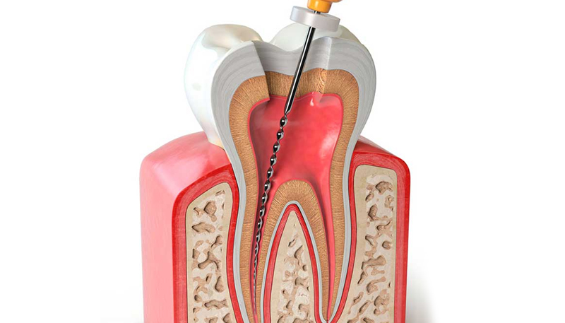Endodoncia